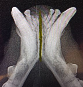 Fractured Jaw x-ray highlight